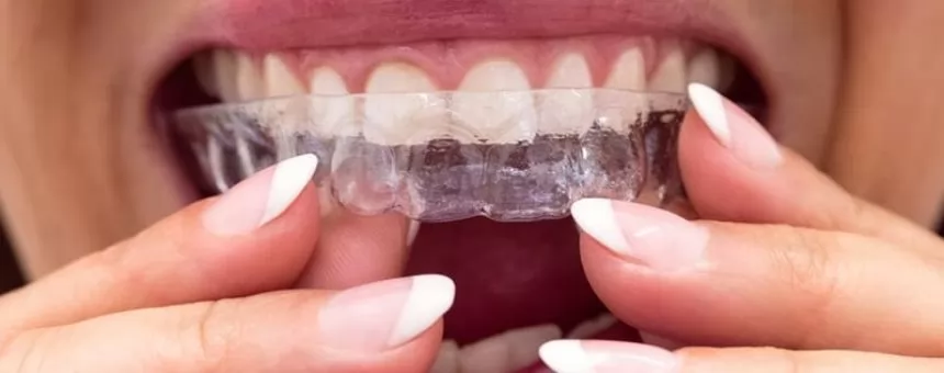 Şeffaf Plak Tedavisi