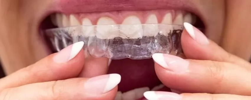 Şeffaf Plak Tedavisi